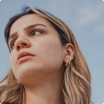 Boutons après l’été – Mythe ou réalité